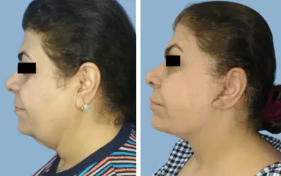 Before and After