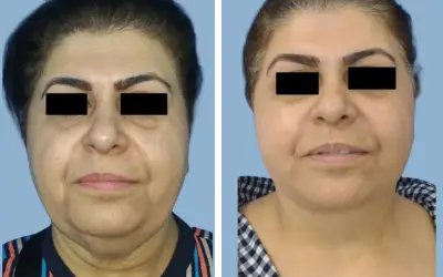 Before and After