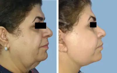 Before and After