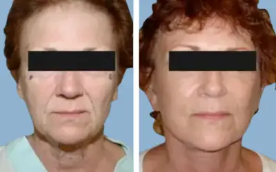 Before and After