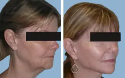 Before and After
