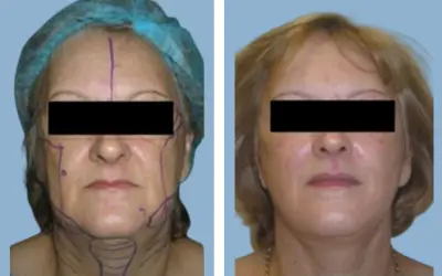 Before and After