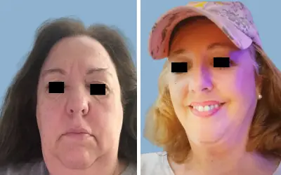 Before and After