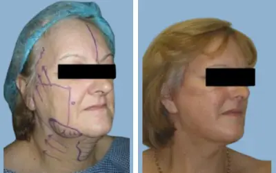 Before and After