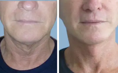 Before and After