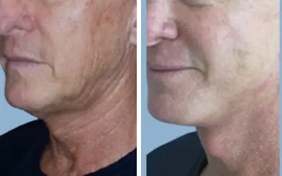 Before and After