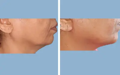 Before and After