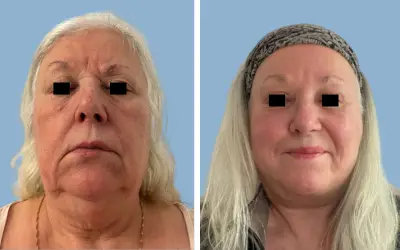 Before and After