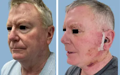 Before and After