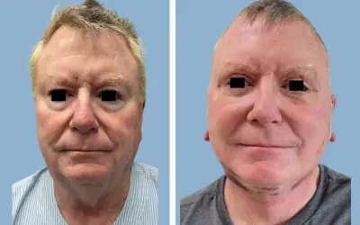 Before and After