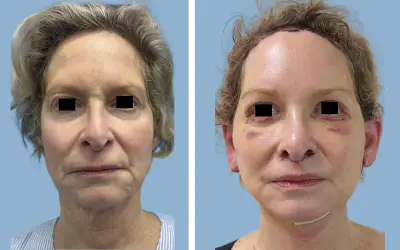 Before and After