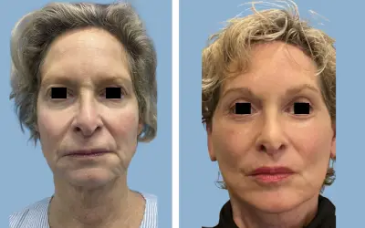 Before and After