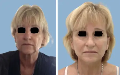 Before and After