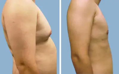 Before and After