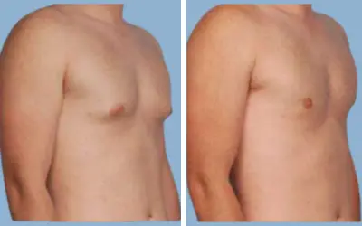 Before and After