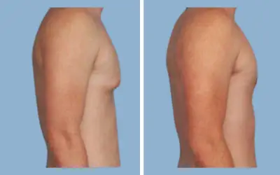 Before and After