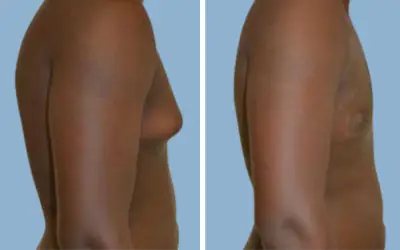Before and After