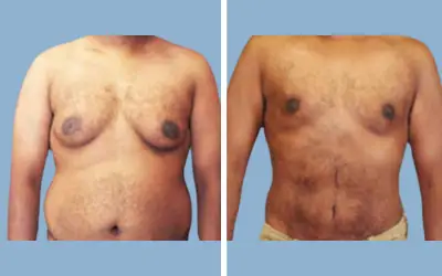 Before and After