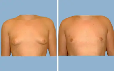 Before and After