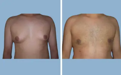Before and After