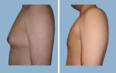 Before and After