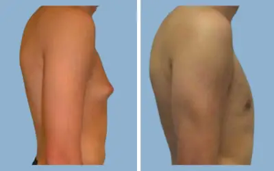 Before and After