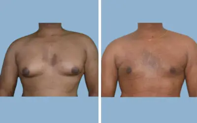 Before and After