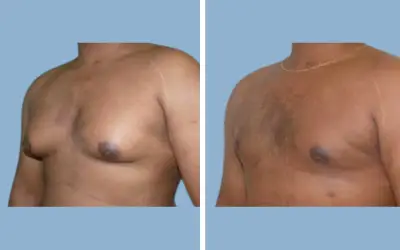 Before and After
