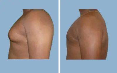 Before and After
