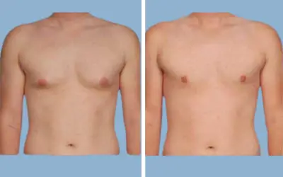 Before and After