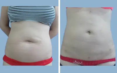 Before and After