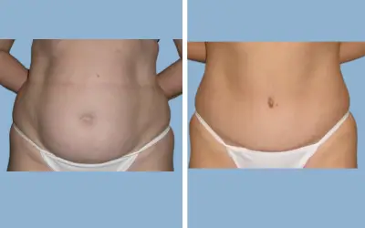 Before and After