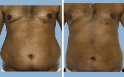 Before and After