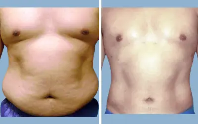 Before and After