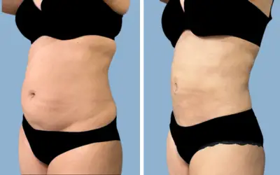 Before and After