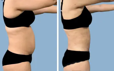 Before and After