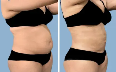 Before and After
