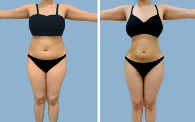 Before and After