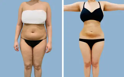 Before and After