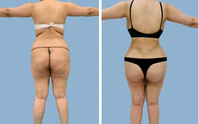 Before and After