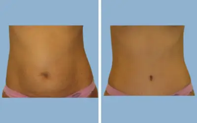 Before and After