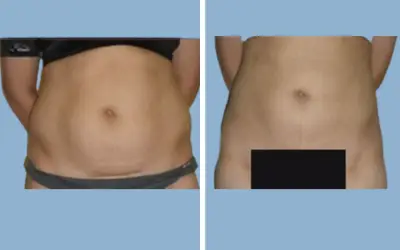 Before and After