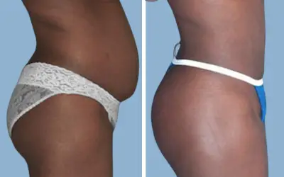 Before and After