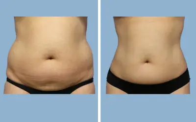 Before and After