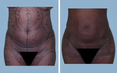 Before and After