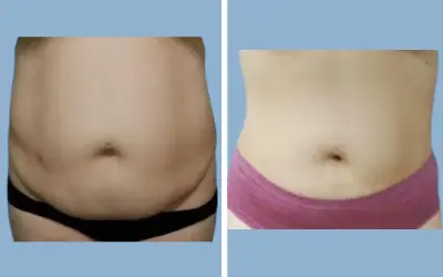 Before and After