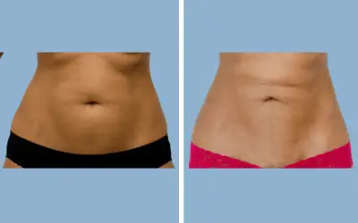 Before and After
