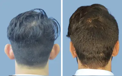Before and After