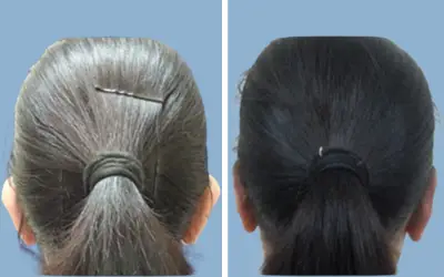 Before and After
