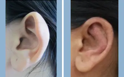 Before and After